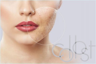 Коллост®  – коллагеновый комплекс для омоложения и восстановления кожи
