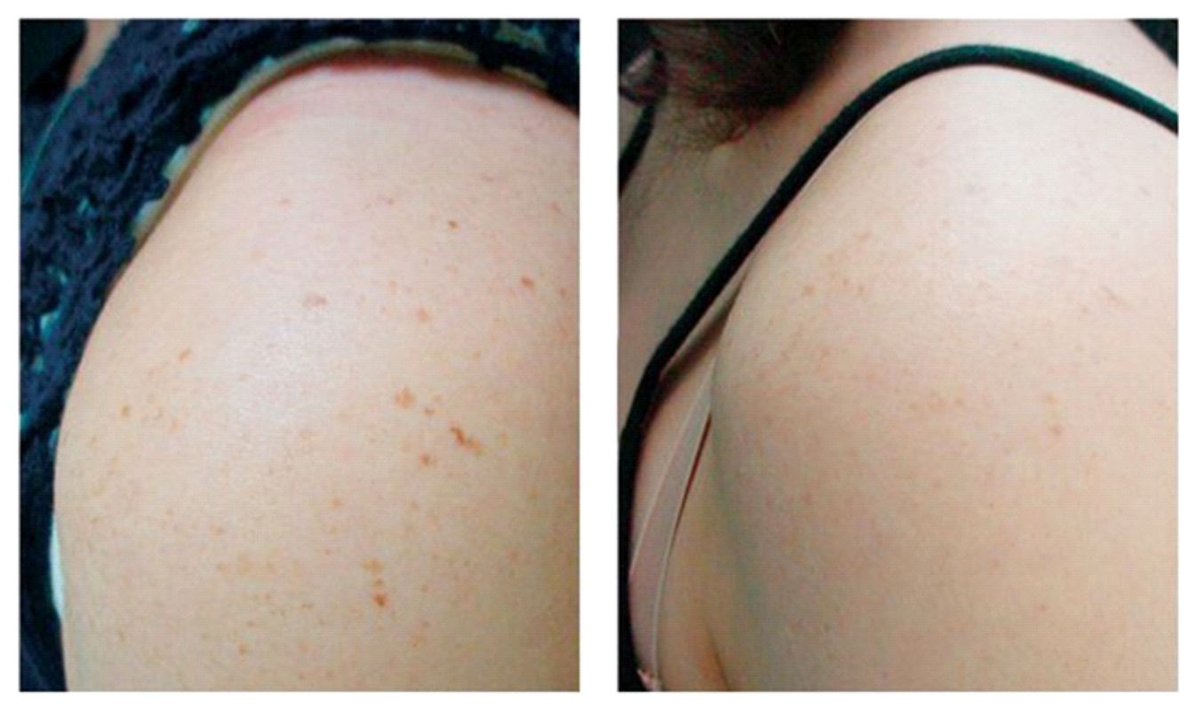 Удаление пигментных пятен в Подольске